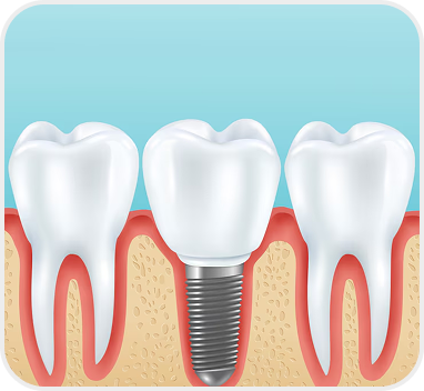 Dental Implants